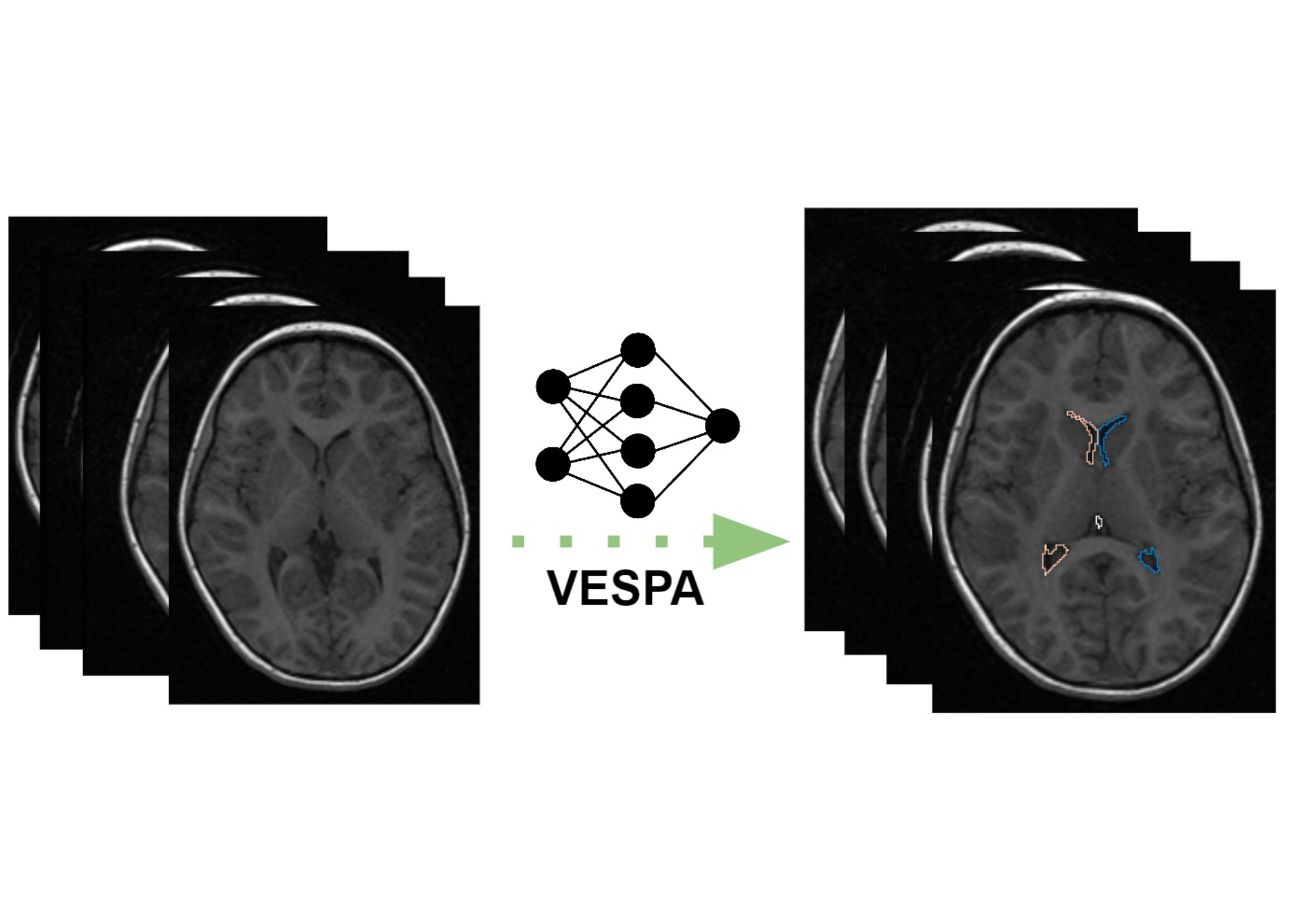 graphic depicting VESPA processing of brain images