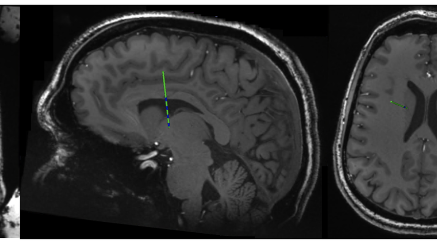 brain MRIs showing location for deep brain stimulation