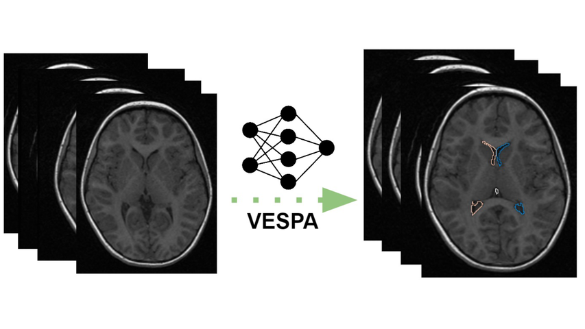 graphic depicting VESPA processing of brain images